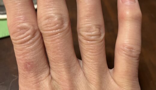 へバーデン結節につき、指がちょい痛い。